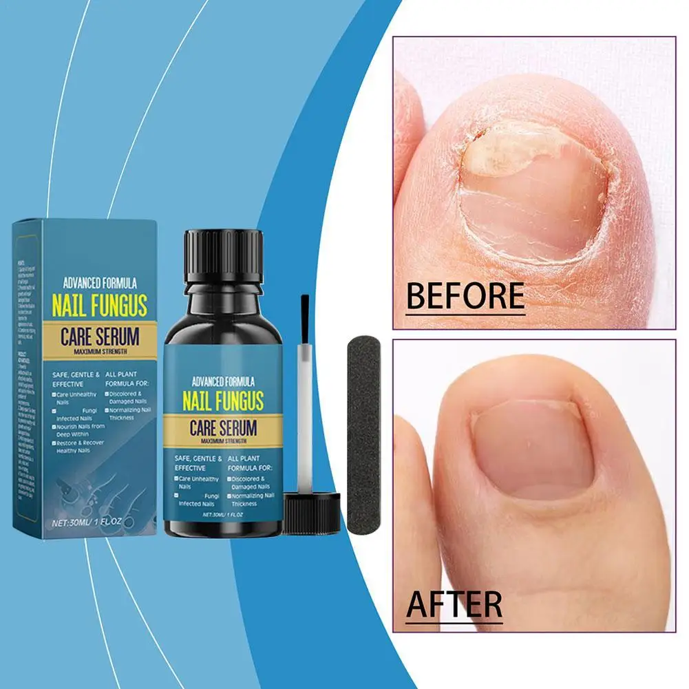 Nail Fungus Treatment Serum Foot Repair Liquid Toe Nails Fungal Removal Gel Anti Infection Paronychia Onychomycosis Cream 30ml