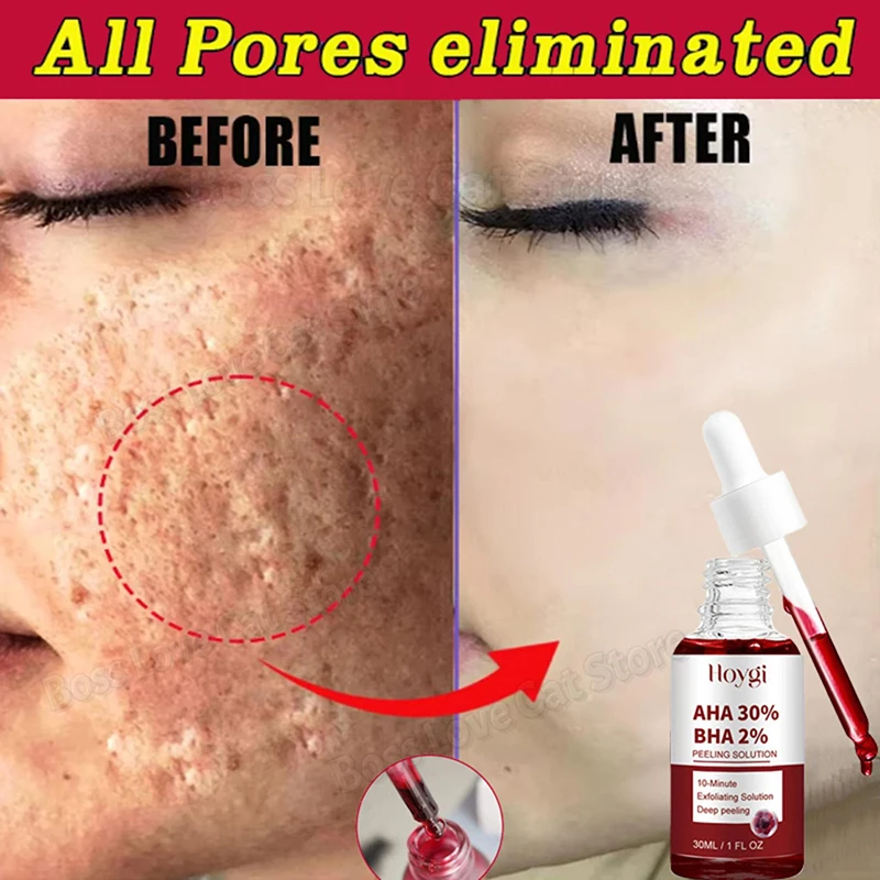 Sérum de rétrécissement des pores, peeling du visage, remodelé, grands pores, resserrement, réparation du visage, minimisant les pores, extinction