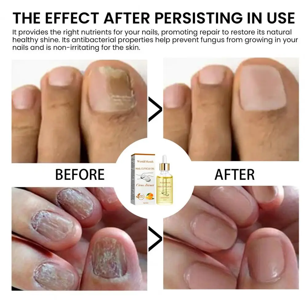 Óleo de fortalecimento de cutículas e unhas, Óleo hidratante para saúde, Ingredientes naturais, Cabelo rápido denso