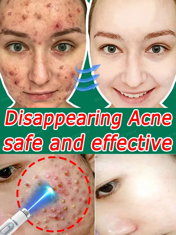 

Acne Cream Remedy Anti Pimple Marks Serum