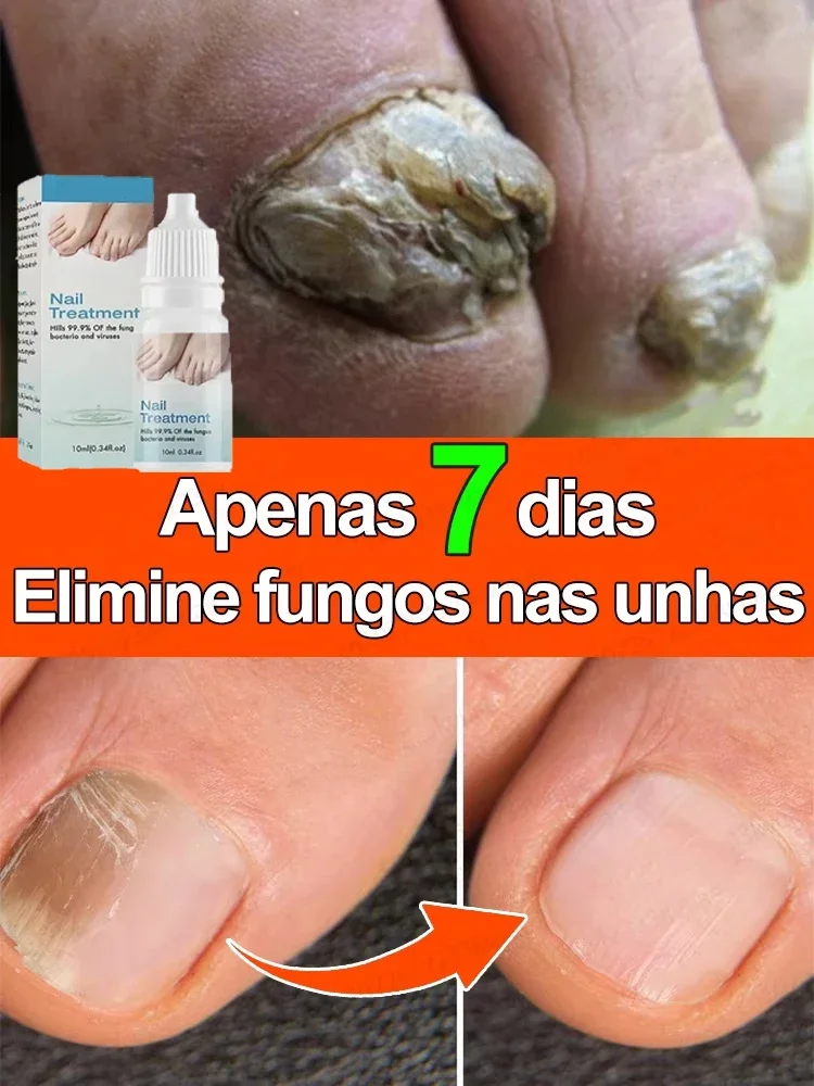 

Onychomycosis foot repair solution for Discolored Thickened Crumbled Nails Nail Fungals for Discolored Broken Cracked