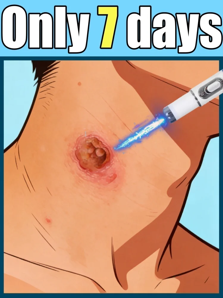 

Набор ручек унисекс с несколькими эффектами и синим светом: попрощайтесь на бородавки