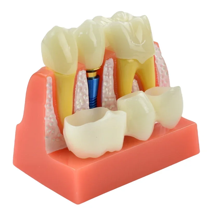 Dental Teach 4 Times Implant Analysis Crown Bridge Removable Model Dental Demonstration Teeth Model Dentisty Lab Material