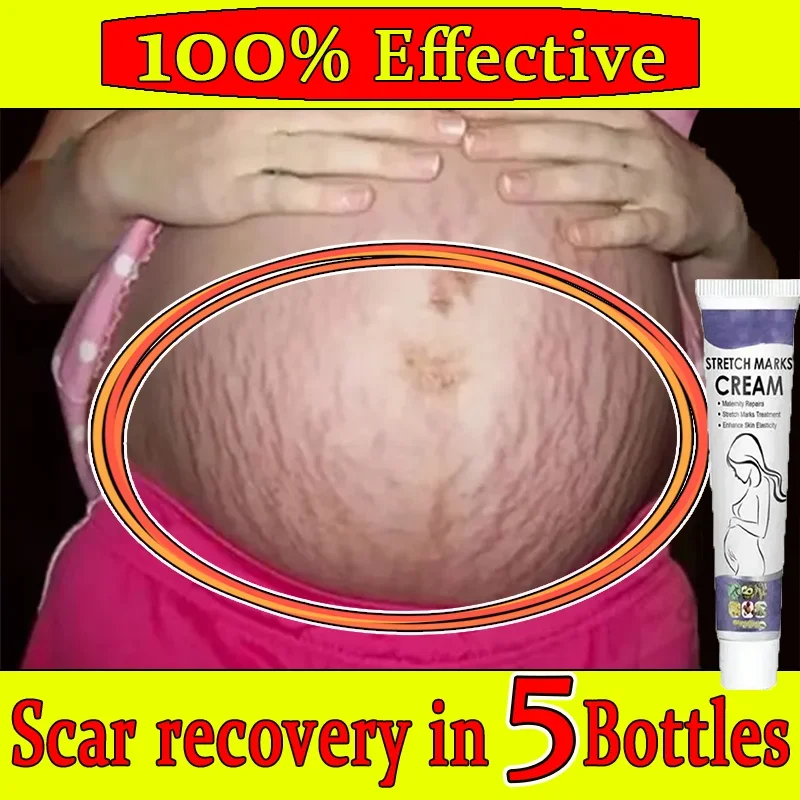 

Stretch Marks Remover Pregnancy Maternity Body New Old Stretch Remove Marks Lifting Firming Increase Elasticity Of Skin