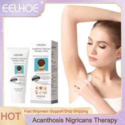 Body Whitening Cream Bleach Dark Knuckle Armpits Elbow Knee Legs Nourishing Brighten Skin Tone Exfoliate Lighten Melanin Lotion