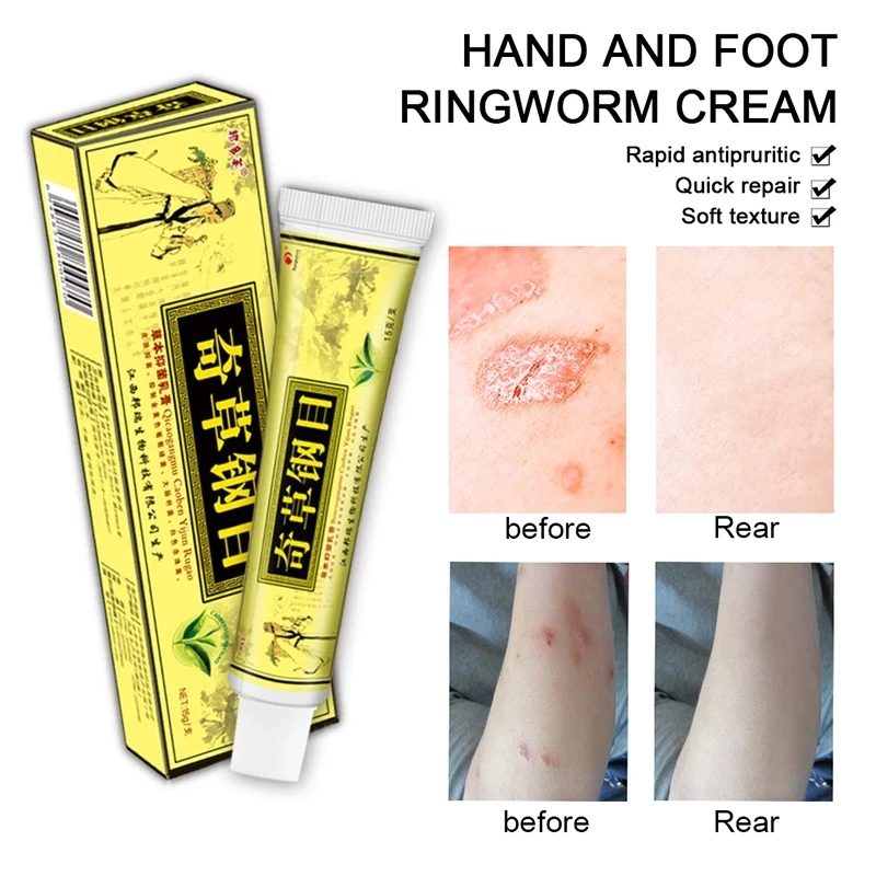 10PCS/YIGANERJING QICAOGANGMU Skin PsoriasisDermatitis Eczematoid Cream Give 5 Gifts