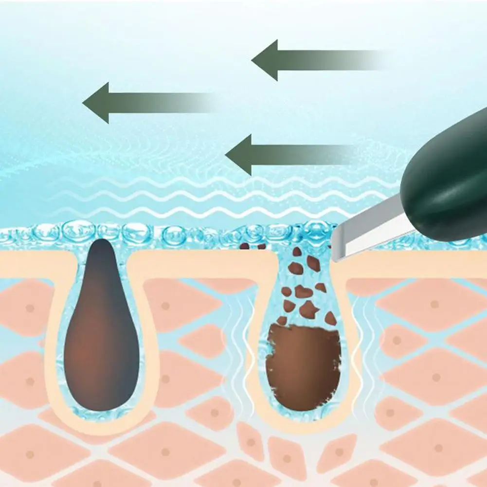 Outil de suppression des points noirs et blancs, mini épurateur de peau, dissolvant de points noirs, nettoyage en profondeur des pores du visage, excavatrice portable, nettoyant, spat V1Q5