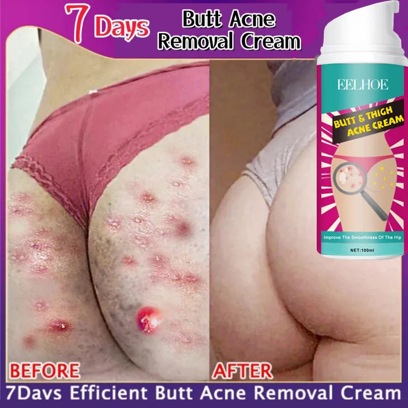 

Body Acne Removal Cream Treatment Face Butt Back Acne Marks Smooth Repair Chicken Skin Cream Moisturizing Whitening Skin Care