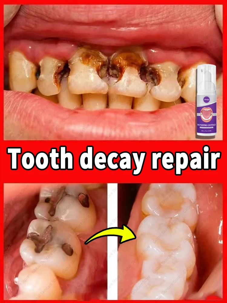 

Solves caries and tooth decay problem