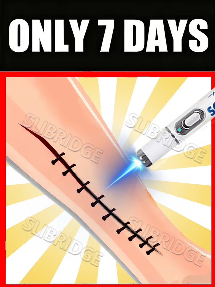 

Generation-2 Blue light pen Says Goodbye To all scar In 7 Days