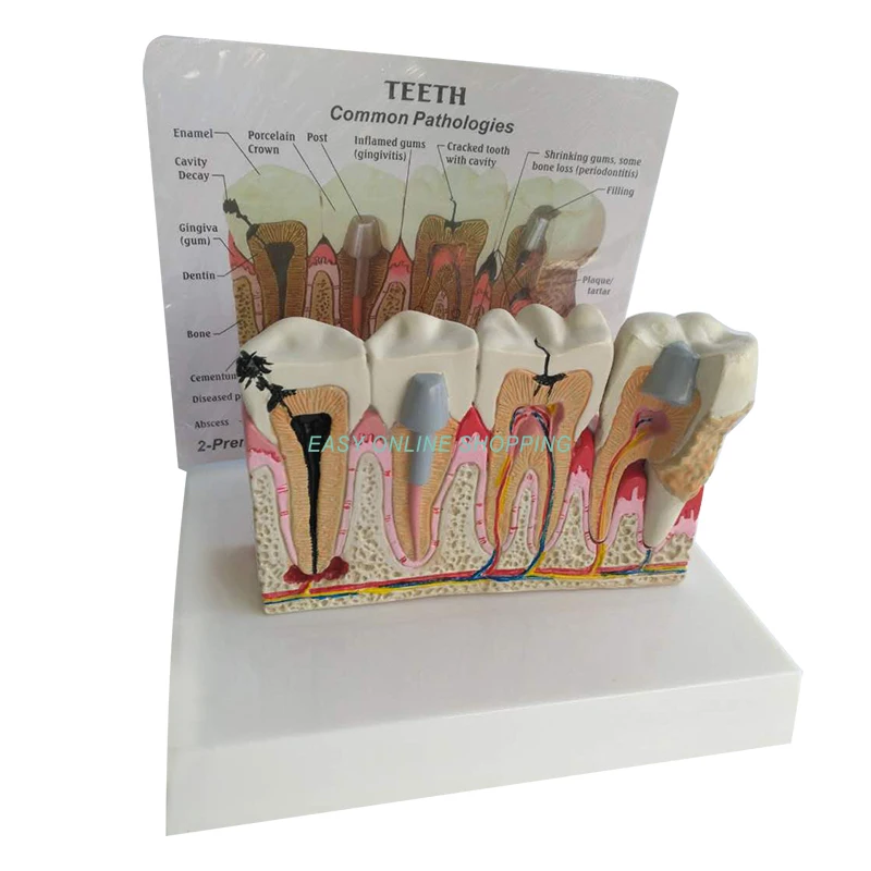 Teeth Anatomy Model Tooth decay Teeth common pathologies Teeth Oversized Anatomy Teaching Research Showcase Model