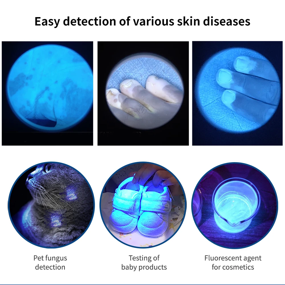 YouWeMed-Lámpara de madera, analizador de piel uv, prueba de Vitiligo, examen de aumento, detección de hongos para mascotas, luz de musgo para gato