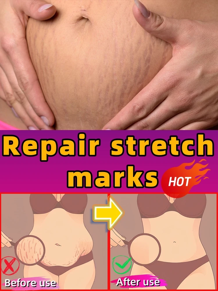 

7 days to repair stretch marks