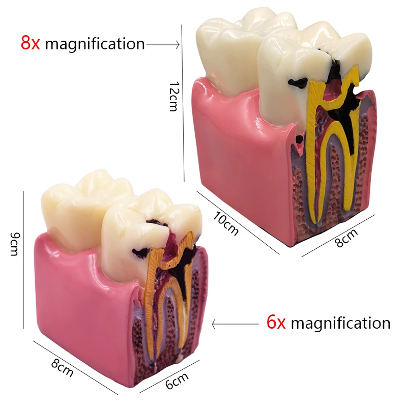 Modello di impianto dentale 6/8x Modello di dente a contrasto di carie ingrandite Modelli di impianti dentali a corona per la comunicazione medico-patiente