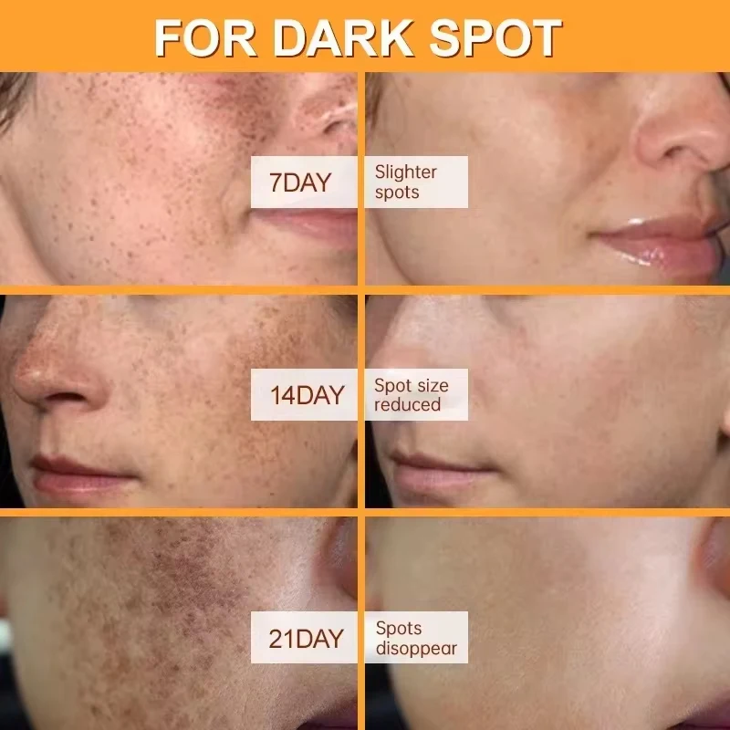 Powerful Dark Spots Remover Freckle Whitening Cream Melanin Correcting Anti Pigmentation Brighten Korean Day Night Facial Care