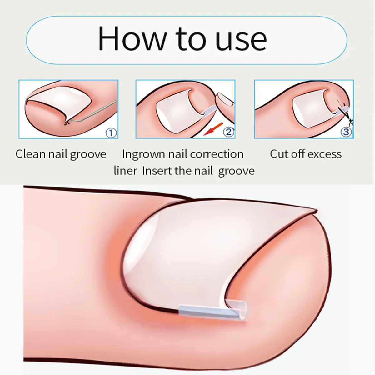 10pcs Ingrown Toenail Correction Tool Ingrown Toe Nail Treatment Elastic Patch Sticker Straightening Clip Brace Pedicure Tool image 6