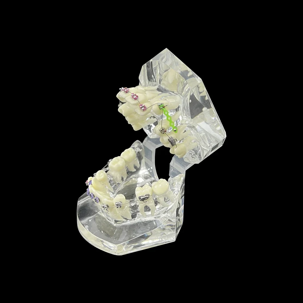 Orthodontic Dental Model With Anchorage Nail Metal Bracket Ortho Teeth Model Transparent Typodont Jaw For Teaching Studying Demo