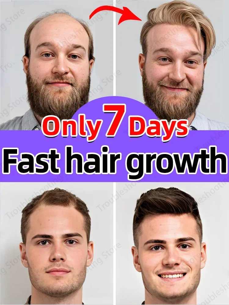 

O óleo de crescimento capilar faz o cabelo crescer rapidamente, repara eficazmente a calvície e a queda de cabelo hereditária