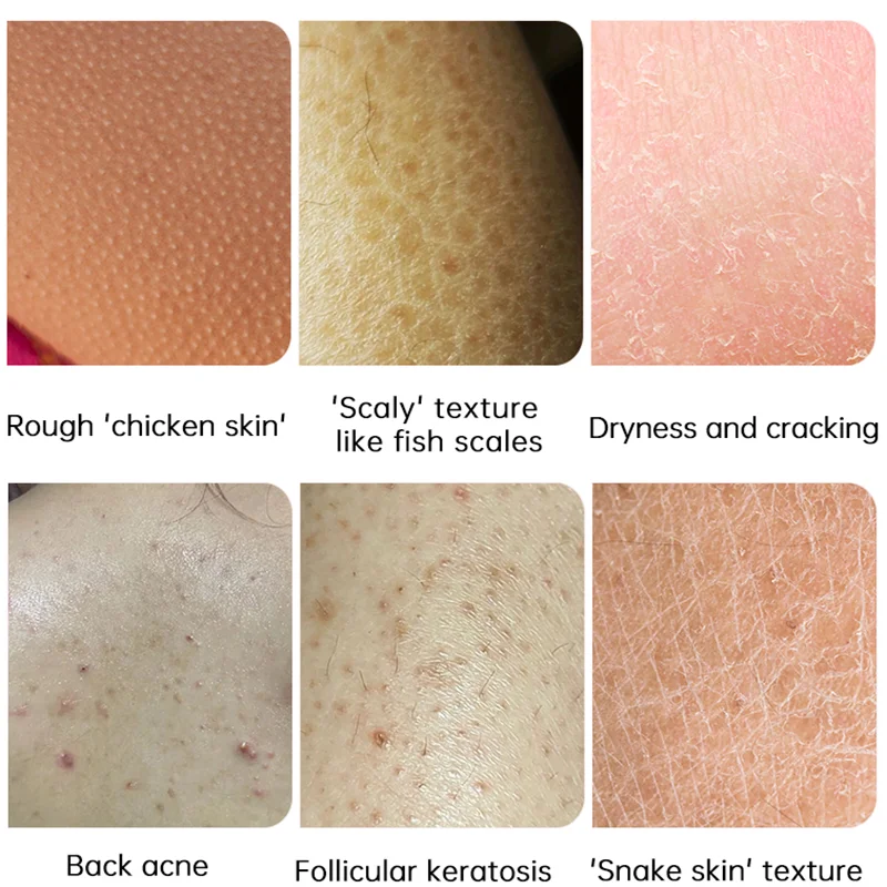 Body Whitening Cream Keratosis Pilaris Treatment Bumpy Rough Chicken Follicle Skin Repair Strawberry Legs Removal Dry Skin Care