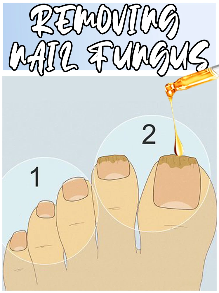 

Blue Laser Device - Nail Fungus Prevention Technology - Adjustable Temperature Control and Safety