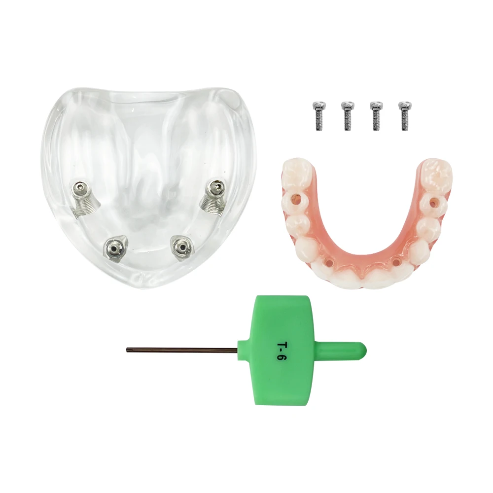 1 szt. Ząb górnopalczarny implantu dentystycznego 4 śruby z mostkiem słupkowym wymienny model odbudowy Typodont dla demonstracji dentystycznej