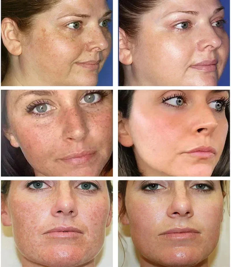 Niacinamida blanqueamiento pecas suero eliminación Melasma manchas oscuras aclara la melanina pigmentación brillo cuidado de belleza antienvejecimiento