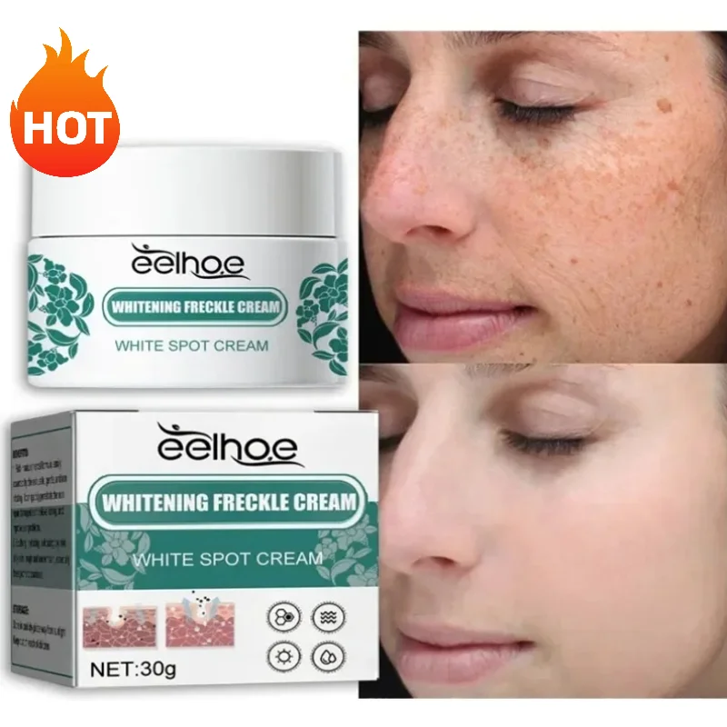 Crema de Melasma descalcida para mujer, reduce la melanina y mejora la sequedad opaca, reposición de humedad Facial, crema para el cuidado de la piel