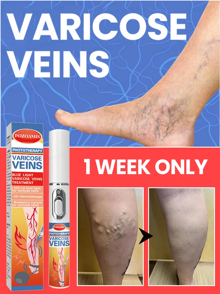 

blue light pen solve varicose veins, hot sale leg care tools