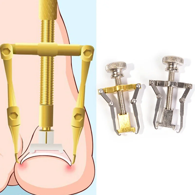 Professional Ingrown Toenail Correction Tool - Orthopedic Fixator for Pedicure & Nail Health