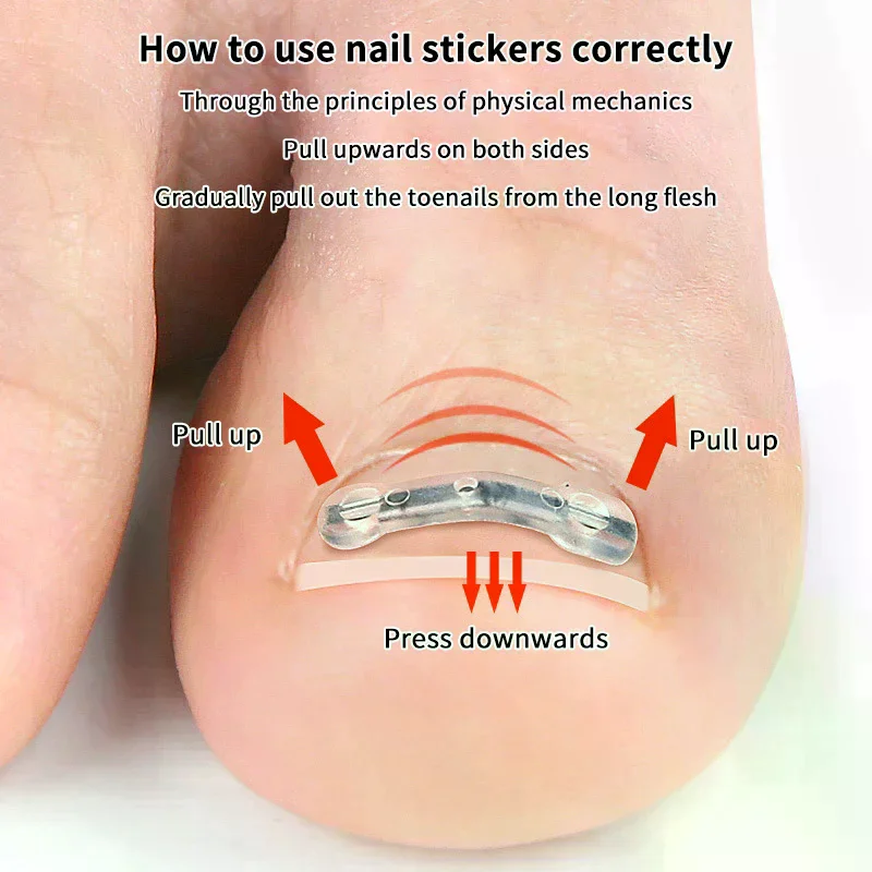 2Pcs Nail Correction Stickers Elastic Ingrown Toenail Corrector Patches Invisible Auxiliary Patch Paronychia Treatment Recover