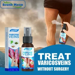 Spray for varicose veins Effective varicose vein relief cream to relieve Leg vasculitis phlebitis spider pain swelling treatment