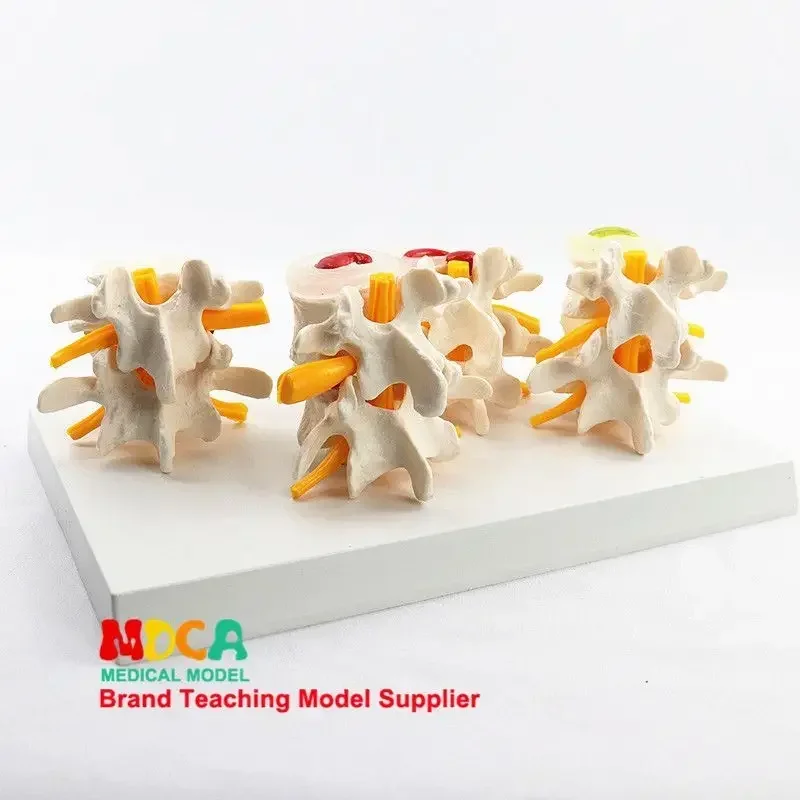 A Quad Type Lumbar Spine Normal And Lumbar Spine And Lesion Combination Model Human Skeleton Model Skeleton Medical Teaching