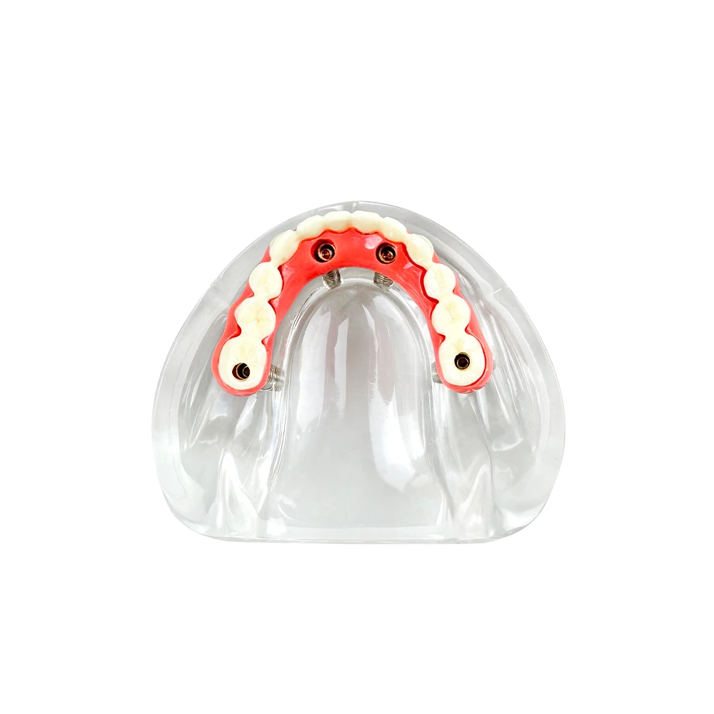 New Dental Implant Model 4 Implants Low Jaw Maryland Bridge Teeth Models Overdenture Restoration Typodont For Education Teaching