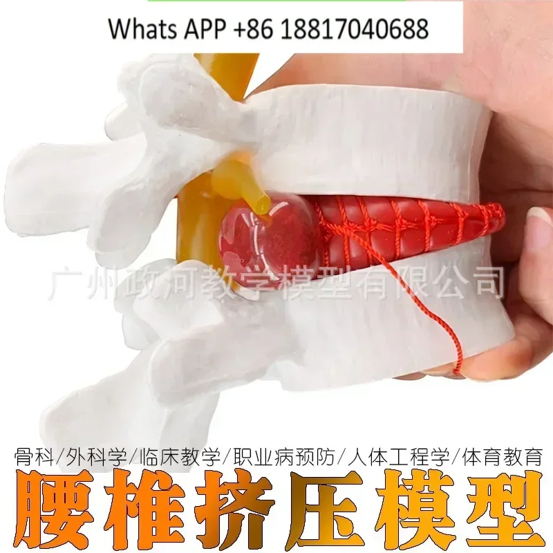 Medical human lumbar disc herniation demonstration model Lumbar spine lesion model Orthopedics Pathological lumbar herniation