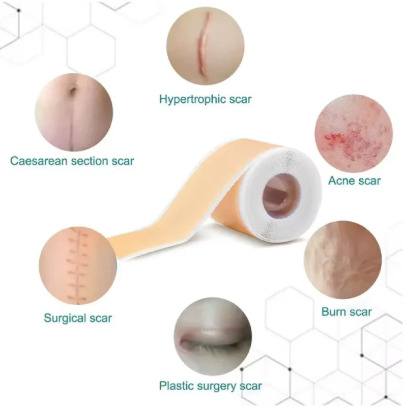 4 سنتيمتر x 150 سنتيمتر سيليكون ندبة ورقة إزالة شرائط هلام السيليكون ندبة قطاع لحب الشباب كيلويد جراحة حرق العلاج ندبة التصحيح Hot البيع