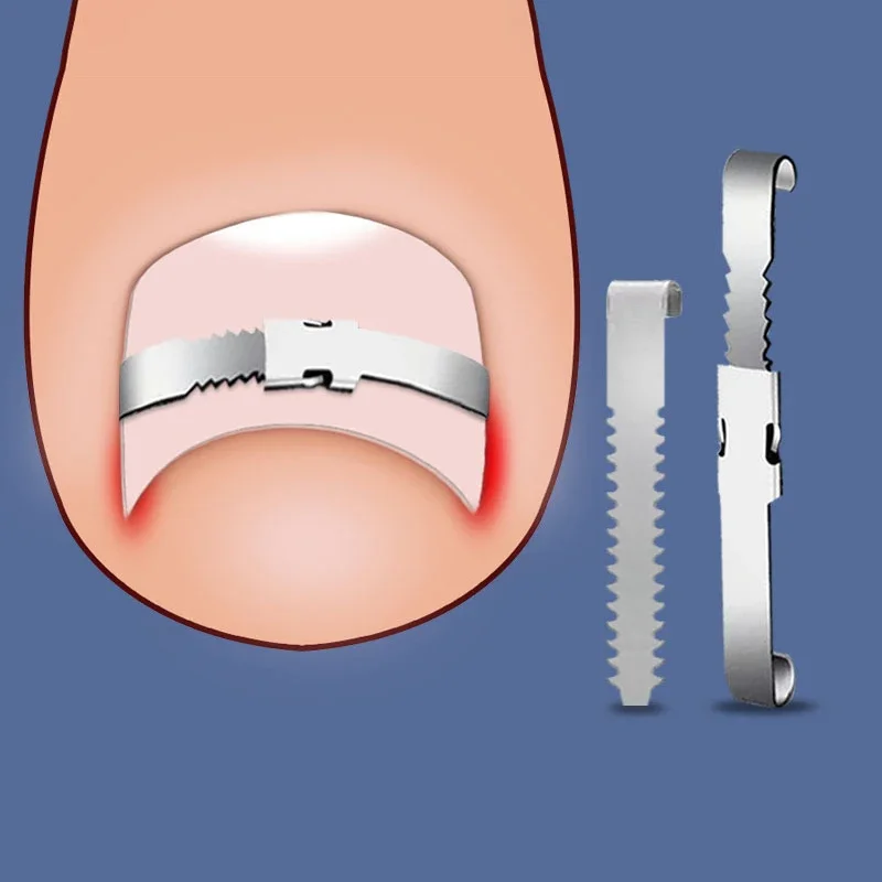 Correcteur d'ongles incarnés, outils de pédicure, récupération intégrée, traitement des ongles des orteils, Correction professionnelle des ongles incarnés, outil de soins des pieds