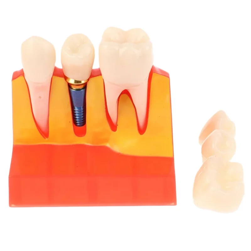 Dental 4Times Implant Teaching Model Removable Crown Bridge Demonstration Dental Doctor-Patient Communication Teaching Aid