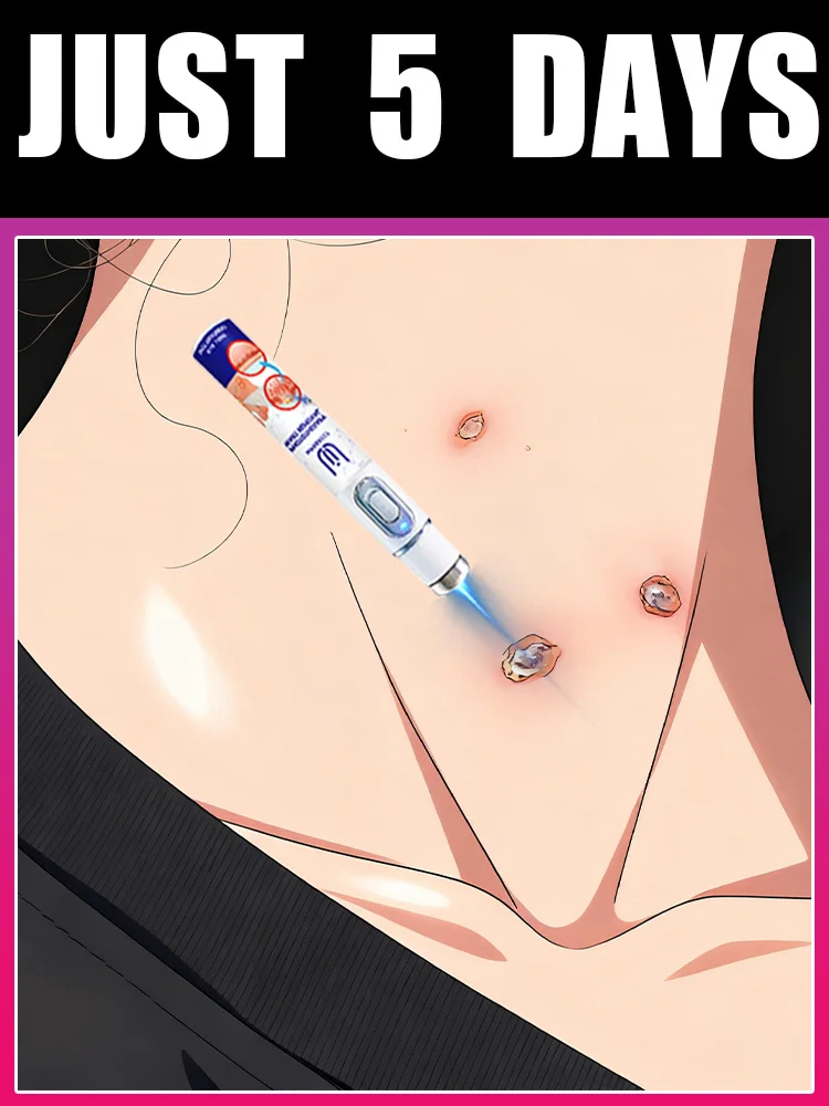 

2025 New Upgrade Blue Laser Solve Wart Tool