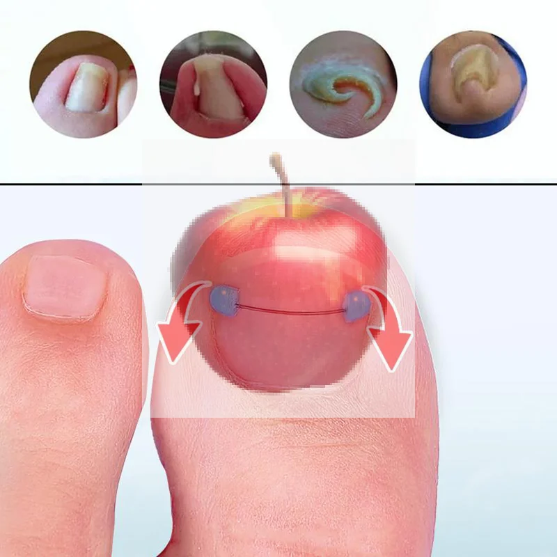 Ingegroeide teennagel Blauwe correctiedraadset Voetverzorging Professionele behandeling Herstellen Embedden Teennagel Pedicure Rechttrekken Teengereedschap