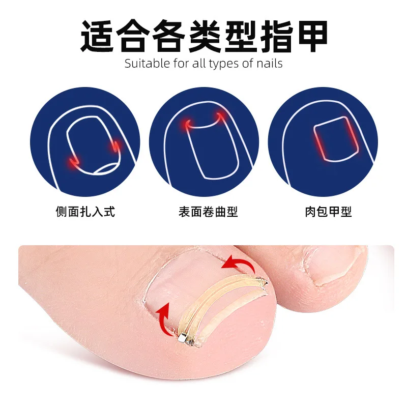 1 set of toe nail ring, stretch rebound nail groove, roll nail, physical reverse stretch, feasible walking, washable, reusable