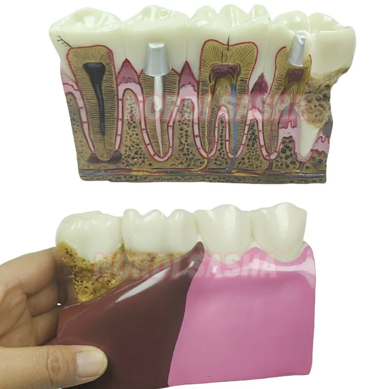 

Dental M4029 Caries Anatomy Model Comprehensive Pathology Tooth Nerve Tooth Model for Oral Teaching Teeth Model