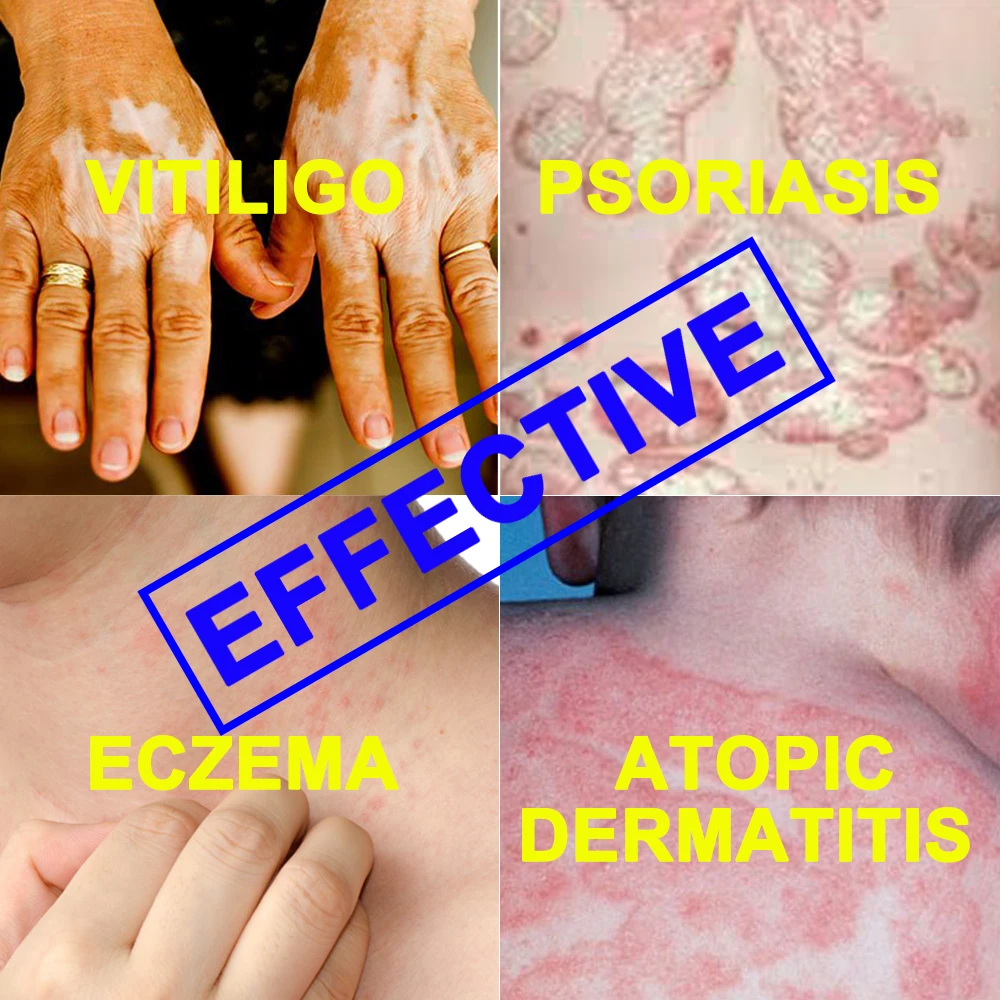 Generali Psoriasis Vitiligo Behandlung Ekzeme