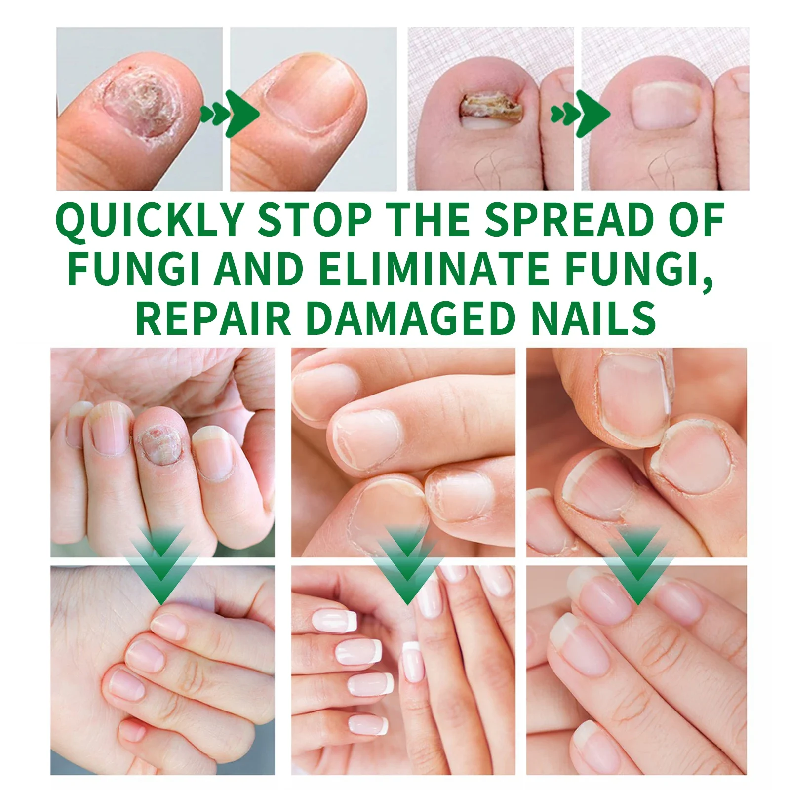 Dispositivo per il trattamento dei funghi delle unghie unghie dei piedi siero per la riparazione dei funghi Anti infezione unghie grigie onicomicosi paronichia rimuovi strumenti