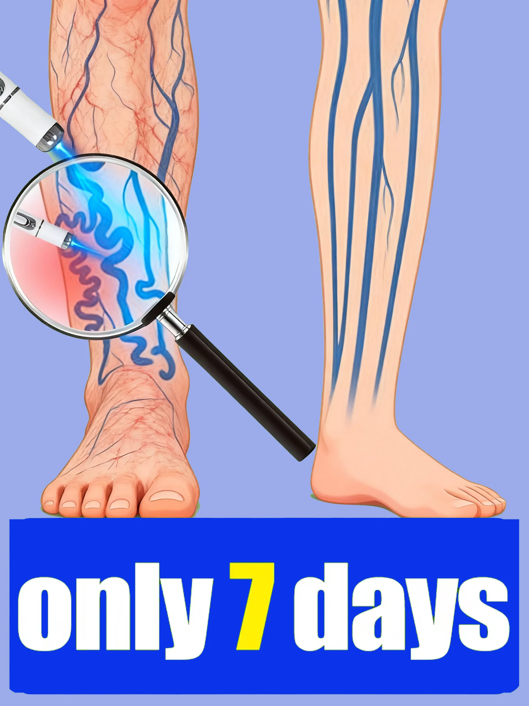 

Blue light pen laser treatment for varicose veins, spider legs for men and women, saving everyone