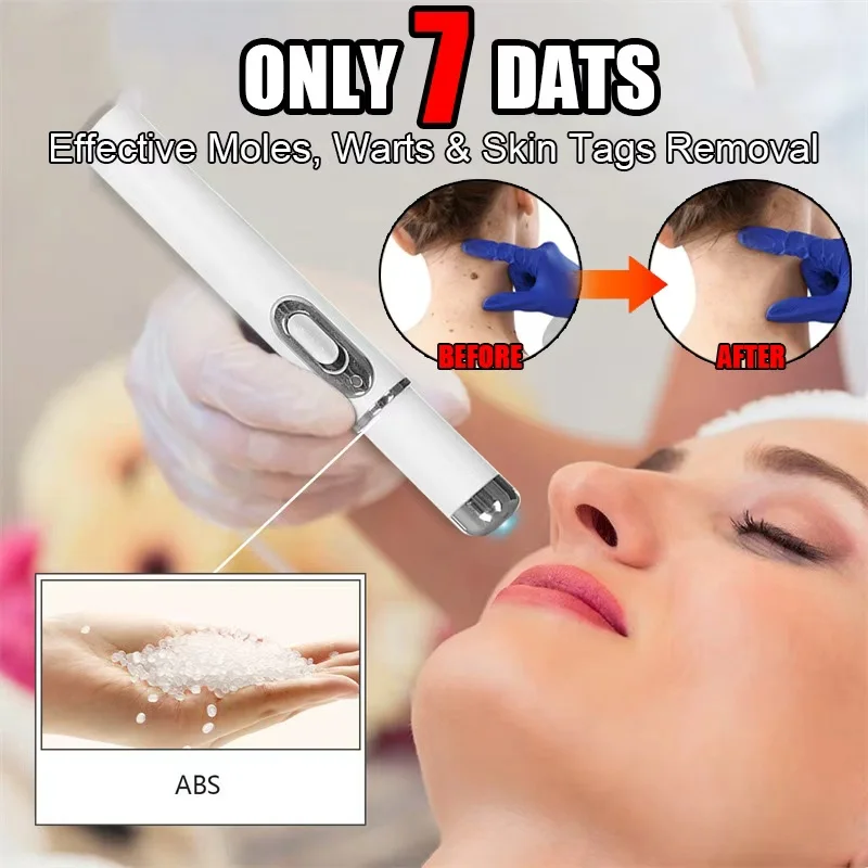 

Ручка с синим светом для отпадания бородавок (максимальная прочность) — общий/подшвенный уход за бородавками, батарейки 5AA в комплект не входят