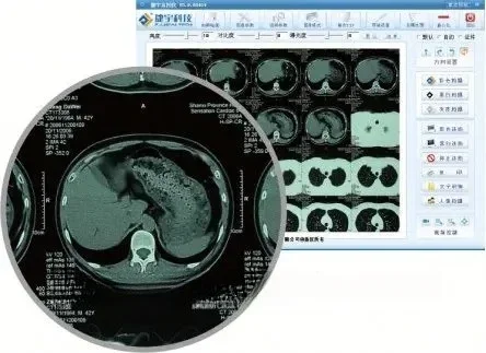 Scanner de filme de raios X Joyusing CT160 para diagnóstico hospitalar e clínico