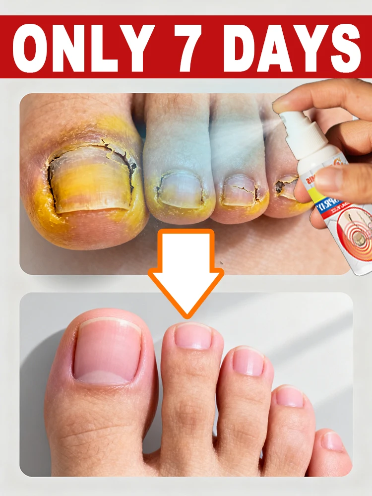 

Prevent foot bacterial infection and ᵒᵈᵒʳ ᵖʳᵒᵇˡᵉᵐˢ ᶜᵃᵘˢᵉᵈ ᵇʸ ᵒⁿʸᶜʰᵒᵐʸᶜᵒˢⁱˢ