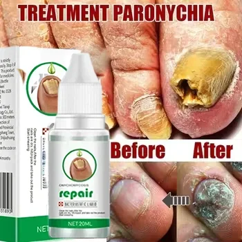 Fungal Nail Treatment Essence Oil Nail Fungus Repair Toenail Fingernail Treatment Onychomycosis with Mushrooms