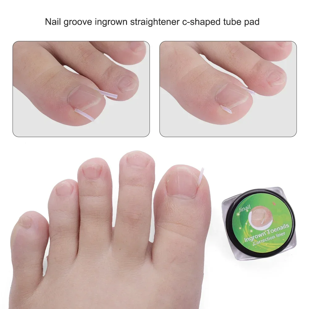 Ingrown Toenail Correção Tiras, Tubo elástico em forma de C Pad, Endireitando Clipes, Paroníquia Correção Toe Nail Tratamento Strip