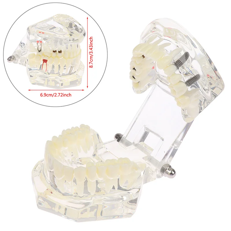 

Dental Implant Teaching Study Disease Teeth Model With Restoration Bridge Tooth Dentist For Medical Science Dental Disease